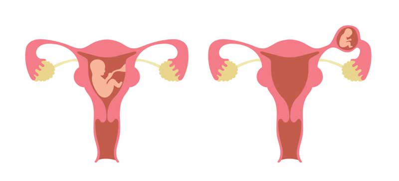 Ectopic Pregnancy Treatment