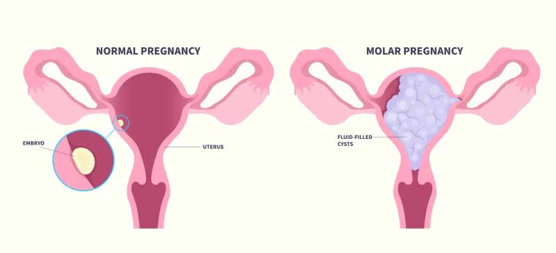 Molar Pregnancy Management