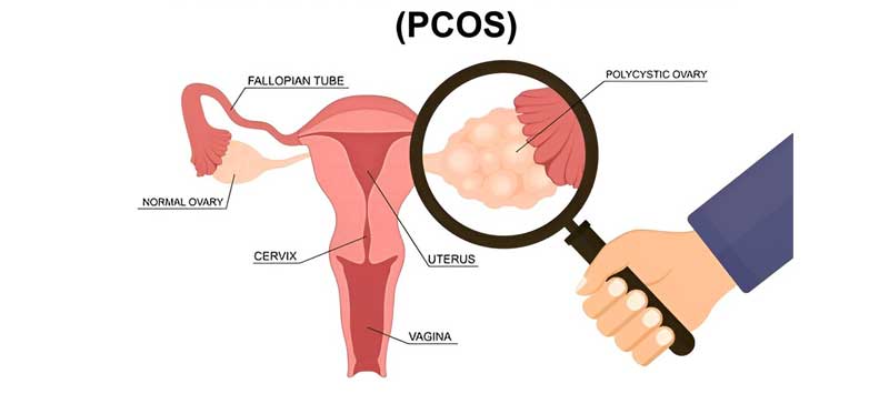 Treatment of PCOD