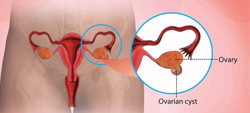 Treatment of Ovarian Cysts