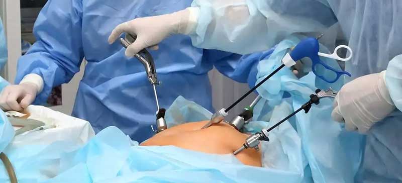 Laparoscopic Open Myomectomy