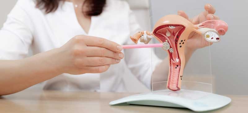 Non Descent Vaginal Hysterectomy NDVH
