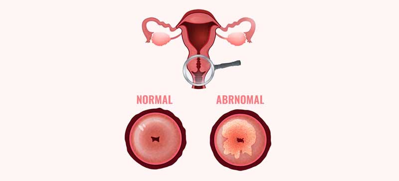 PAP Smear Test
