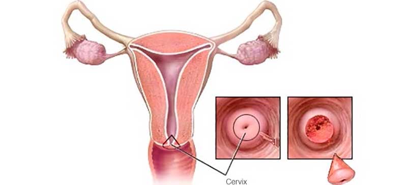 Cervical Biopsy