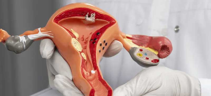 Endometriosis Treatment