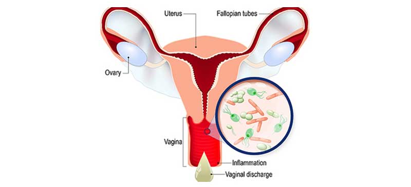 Vaginal Infection Discharge Treatment