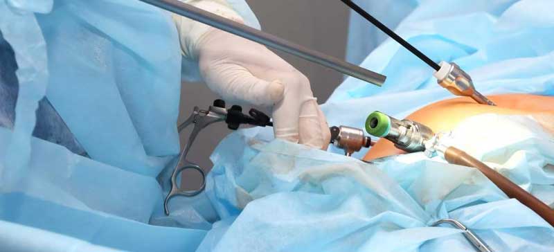 Laparoscopic Open Ovarian Cystectomy