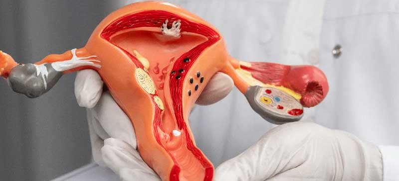 Prolapse Surgery