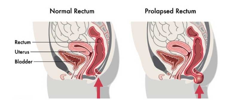 Prolapse Surgery