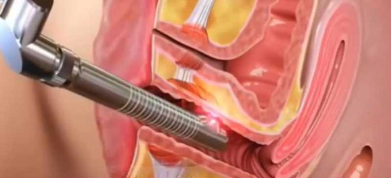 Surgery for Urinary Incontinence